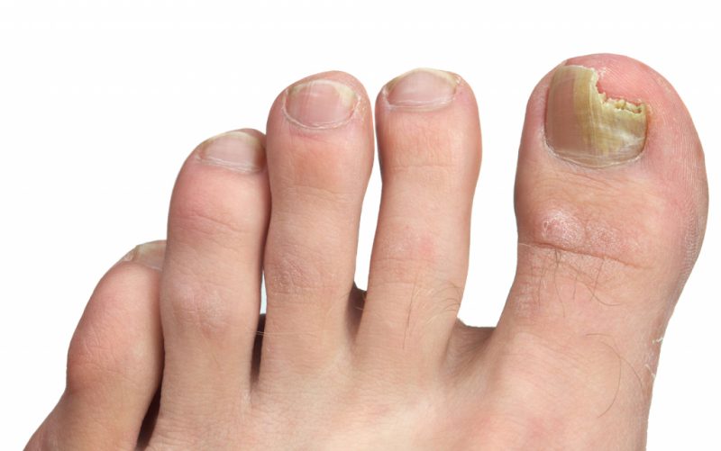 Грибок ногтей. Лечение народными средствами 