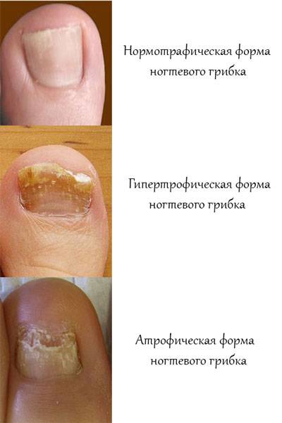 Лечение грибка ногтей на ногах и руках 