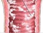Молочница (кандидоз у женщин). Симптомы, причины, диагностика и лечение молочницы. 