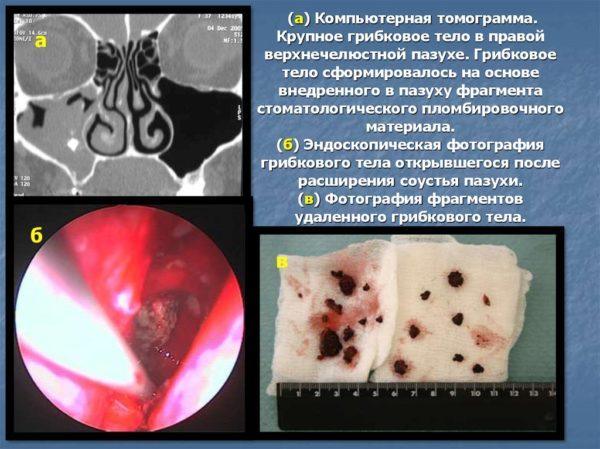 Симптомы и лечение грибкового гайморита у взрослых 