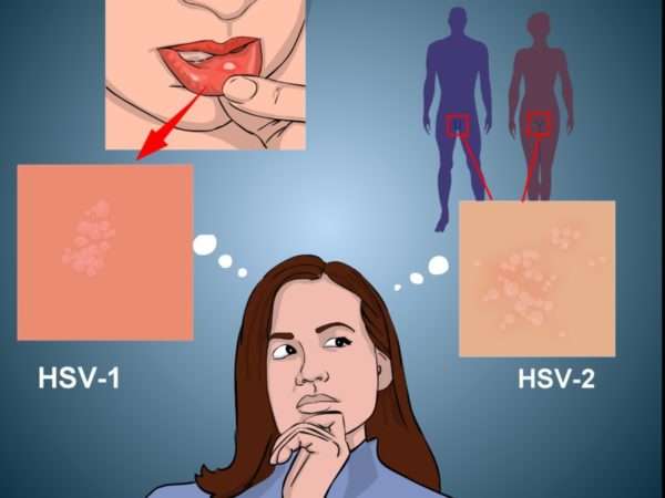 Herpes simplex: описание вируса, его симптоматика, лечение, профилактика 