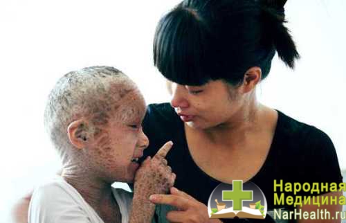 Ихтиоз кожи у ребенка: причины, симптомы с фото, лечение и последствия 