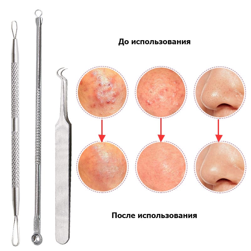Инструменты для выдавливания прыщей и черных точек 