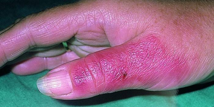 Как и чем лечить рожистое воспаление кожи ноги? 
