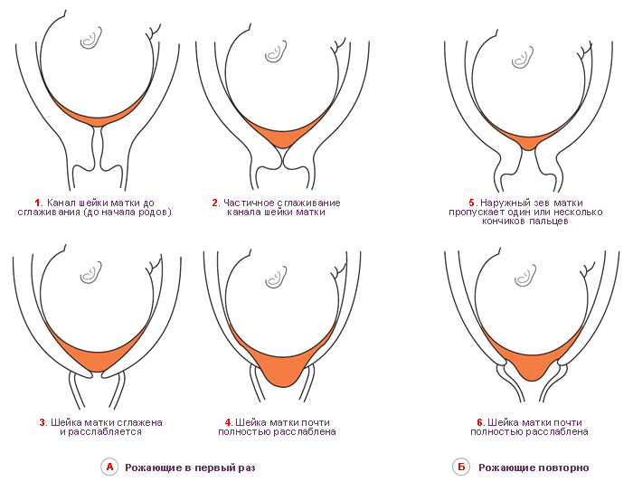 Длинная шейка матки перед родами что делать 