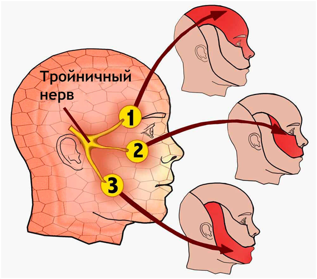 Какими способами лечат воспаление тройничного нерва? 