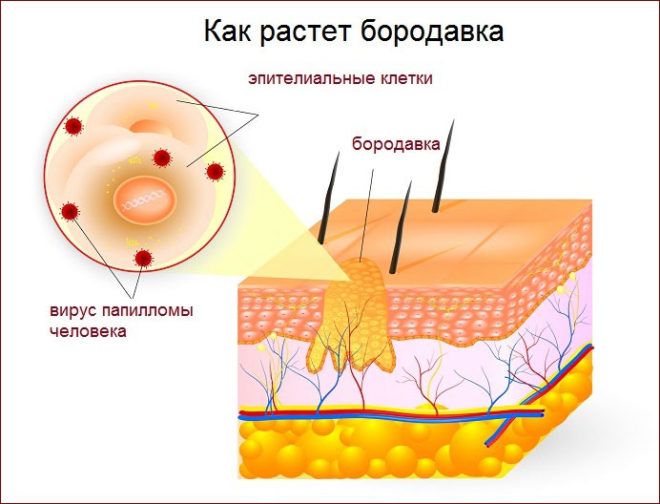 Как избавиться от бородавок на пальце ноги 