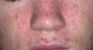 Как лечить дерматит на лице 