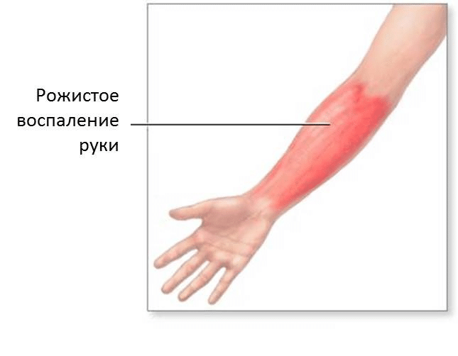 Как лечить рожу на ноге в домашних условиях народными средствами 