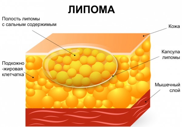 Как образуются и от чего появляются жировики на теле? 