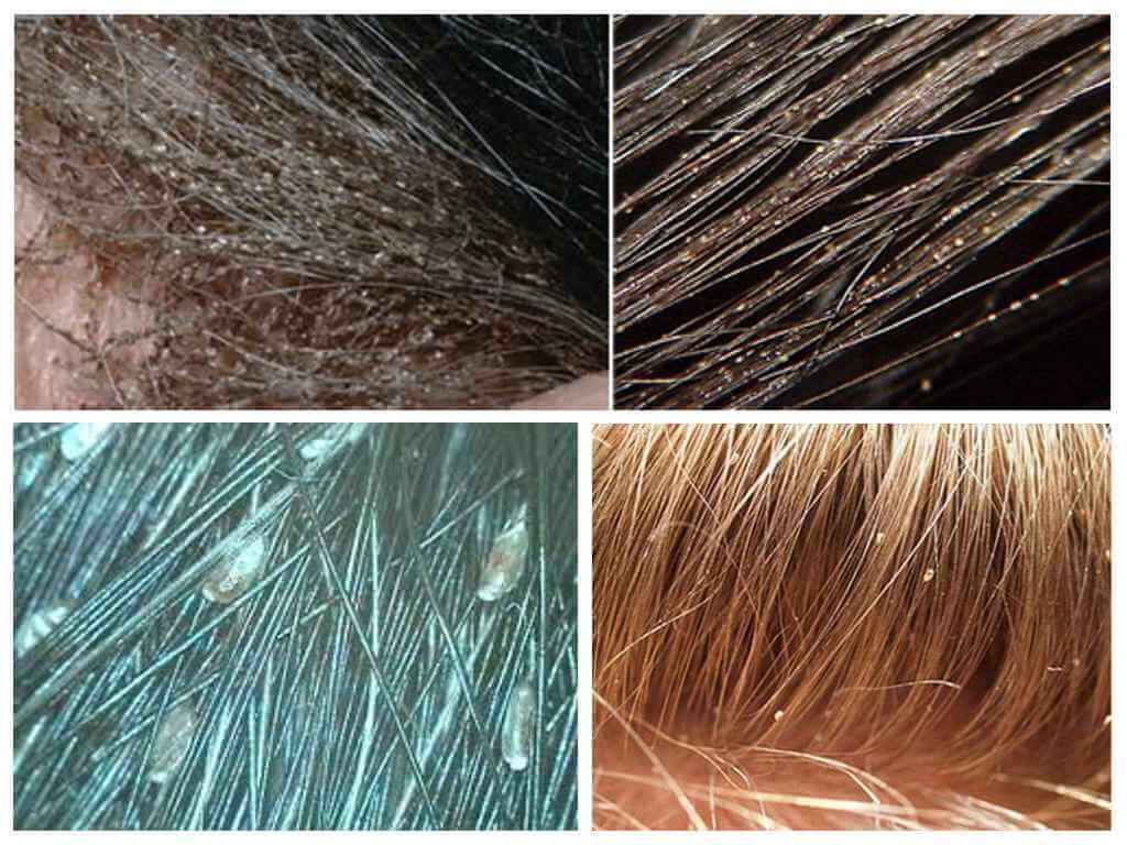 Почему вши появляются только в чистых волосах