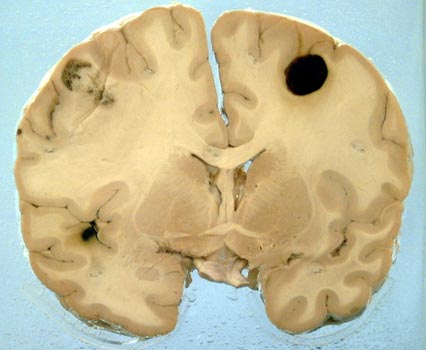 Как распознать и вылечить меланому головного мозга 