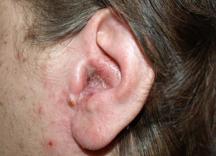 Как распознать появление герпеса в ухе или за ушами? 