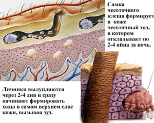 Как выглядит чесотка, чем её лечить? 