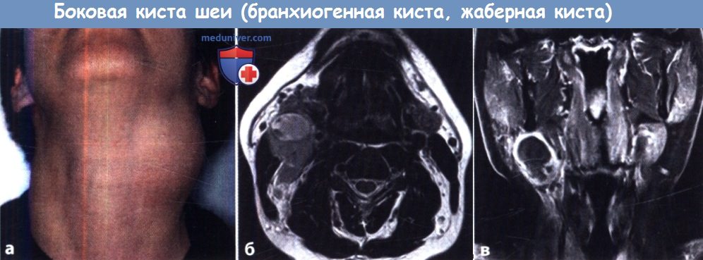 Киста шеи: причины, симптомы, удаление и код МКБ-10 