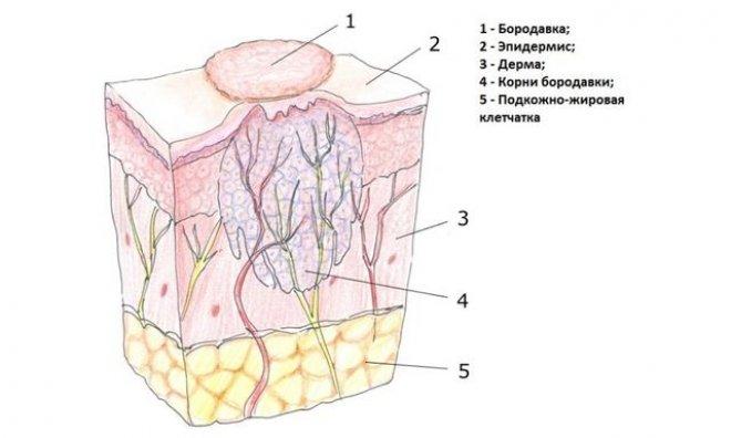 Корень бородавки — строение, образование и удаление. Подробное описание корня и методы избавления бородавки с корнем (85 фото) 