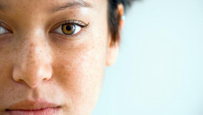 Коричневые пятна на лице: почему появляются и как от них избавиться 