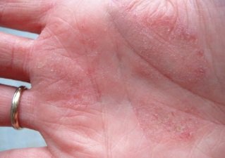 Кожные заболевания на руках: на пальцах, кистях, ладонях 