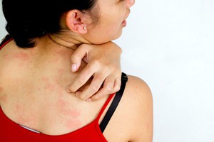 Крапивница — причины и симптомы аллергии, методы лечения 