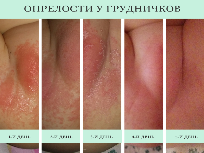 Крема для устранения опрелостей у новорожденных и взрослых 