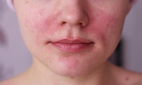 Лечение аллергии на крем для лица 