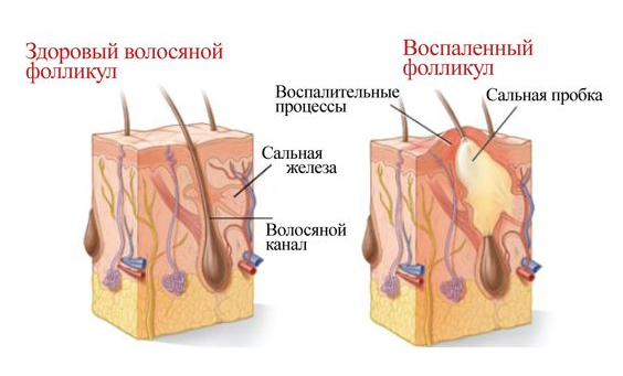 Лечение фурункула на начальной стадии 