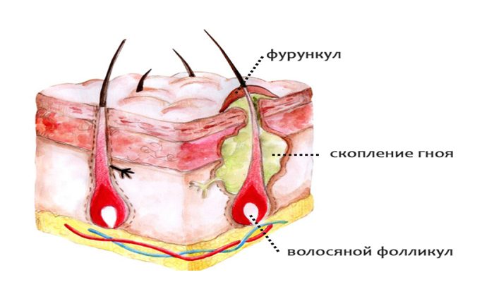 Лечение фурункула в домашних условиях 