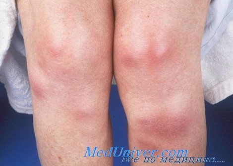 Лечение узловатой эритемы на ногах: 6 методов диагностики 