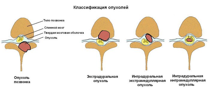 8 признаков paка позвоночника (в том числе боль). Никто не застрахован. 