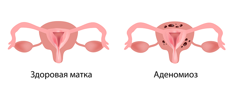 Аденомиоз — симптомы и лечение 