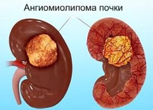 Ангиомиолипома правой и левой почки: опасна ли она для жизни, как проявляется 