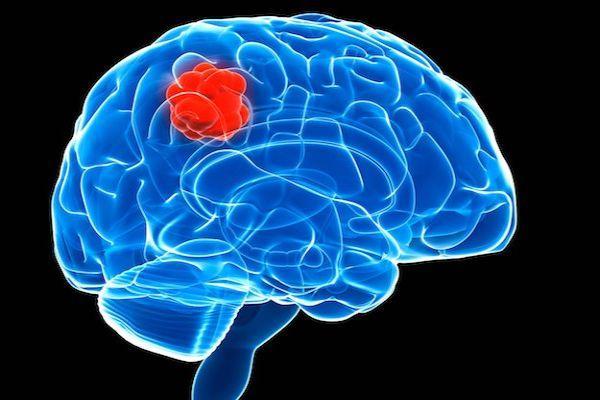 Астроцитома головного мозга: причины, симптомы, лечение, прогноз 