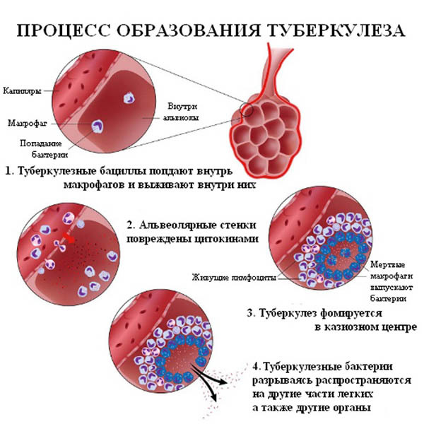 Чем отличаются туберкулез легких и paк легких 