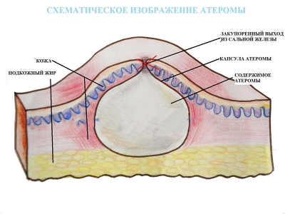 Что такое атерома: симптомы, причины, лечение, фото 