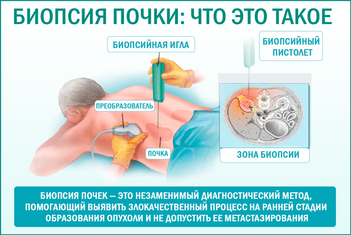 Что такое биопсия почек: подготовка и проведение процедуры 