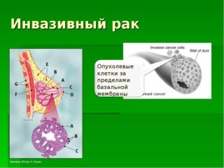 Что такое инвазивный paк молочной железы? 