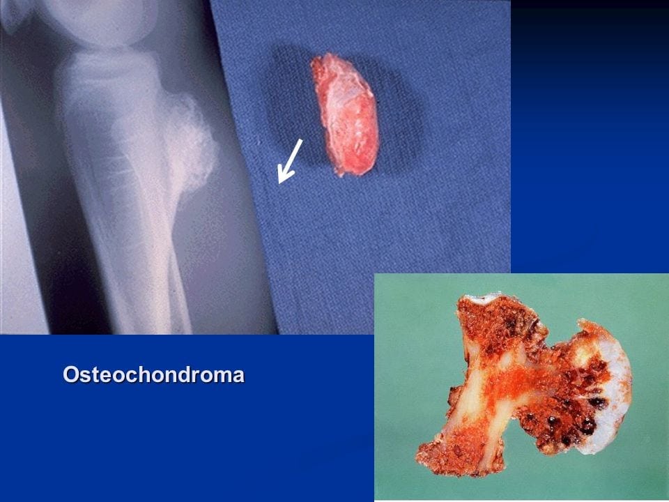 Что такое остеохондрома — основные причины заболевания, лечение новообразования 