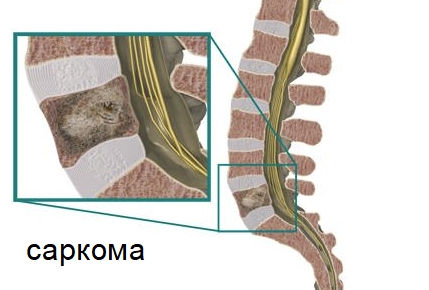 Что такое саркома позвоночника: причины и симптомы заболевания, виды образований и их лечение 