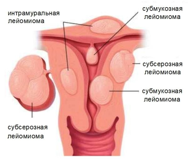 Что такое субмукозная миома 