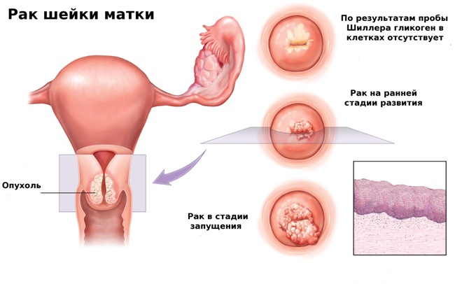 Эффективность прививки против paка шейки матки 