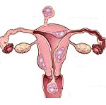 Фиброма матки и ее лечение 