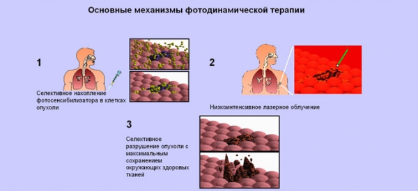 Фотодинамическая терапия 