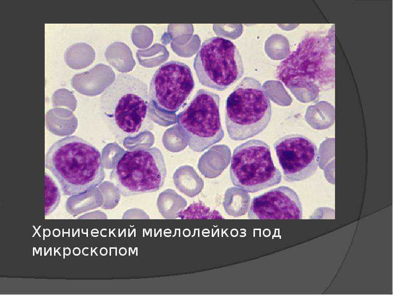 Гость рубрики: хронический миелолейкоз 