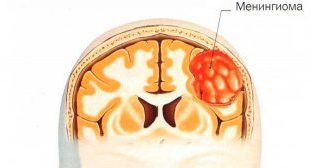 Из-за чего образуется менингиома головного мозга, чем опасно образование 