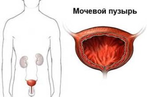 Как не пропустить признаки рака мочевого пузыря у мужчины? Симптомы, диагностика и лечение рака мочевого пузыря у мужчин 