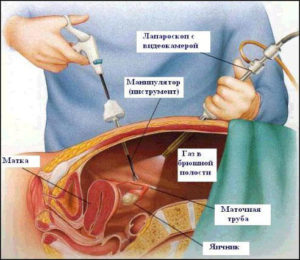 Как проводят лапароскопию миомы матки и сколько это стоит 