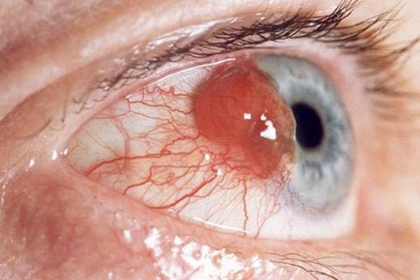 Как выглядит рак глаза? фото и прогноз 