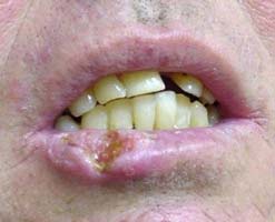 Как выглядит рак губы: симптомы и первые признаки 