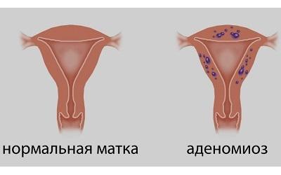 Как забеременеть при аденомиозе самостоятельно или с помощьюЭКО 