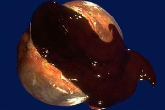Эндометриоидная киста яичника и беременность 5811 0 24.09.2017 